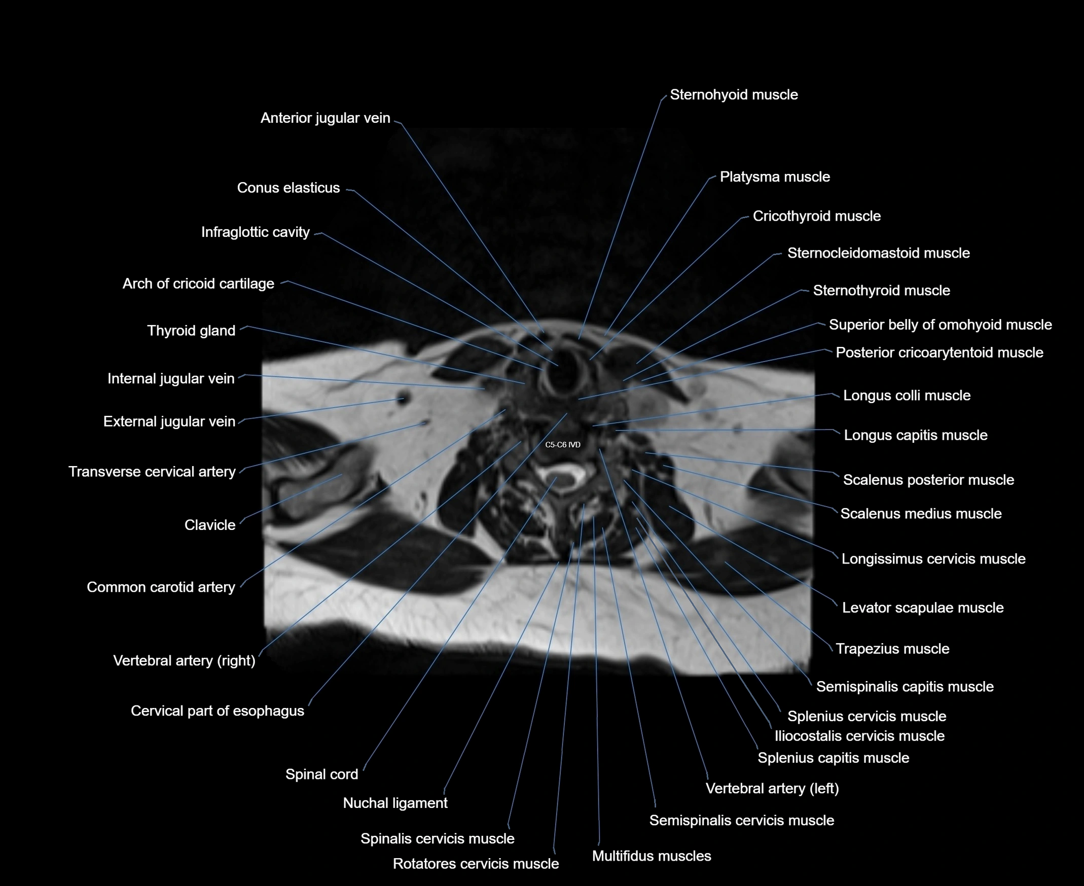 MRI Neck 3D labelled cross section anatomy axial 3t image-00001-00066.webp